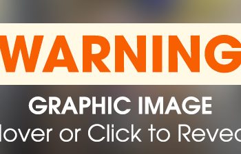 Fierce Maeve Survives Severe Burns and Steals the Hearts of One Family