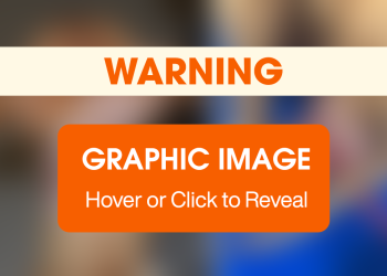 After Recovering From Injuries, This Sweet Dog Sealed the Deal With Her New Family